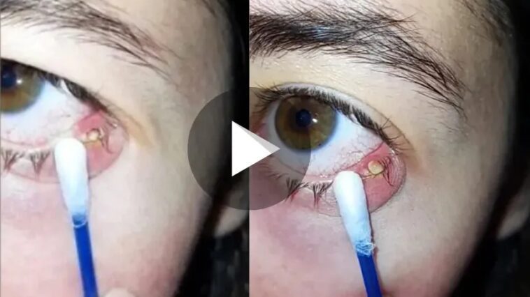 Mulher remove terçol de dentro do olho sozinha: veja como foi